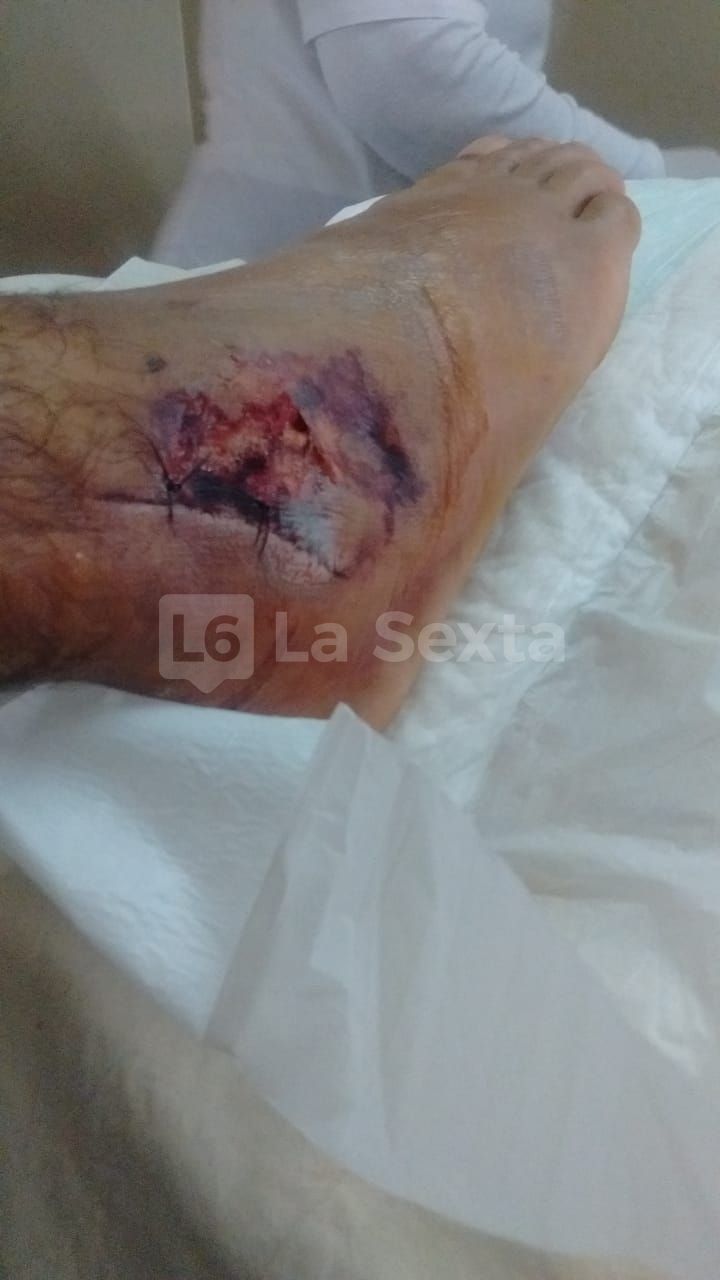 herida obra incompleta santa elena 10 result