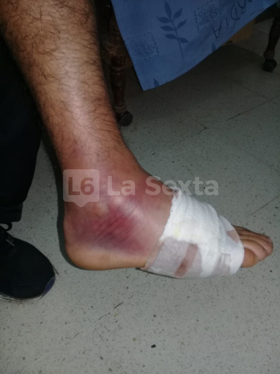 herida obra incompleta santa elena 11 result