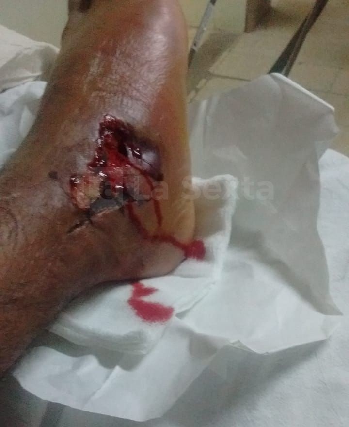 herida obra incompleta santa elena 1 result