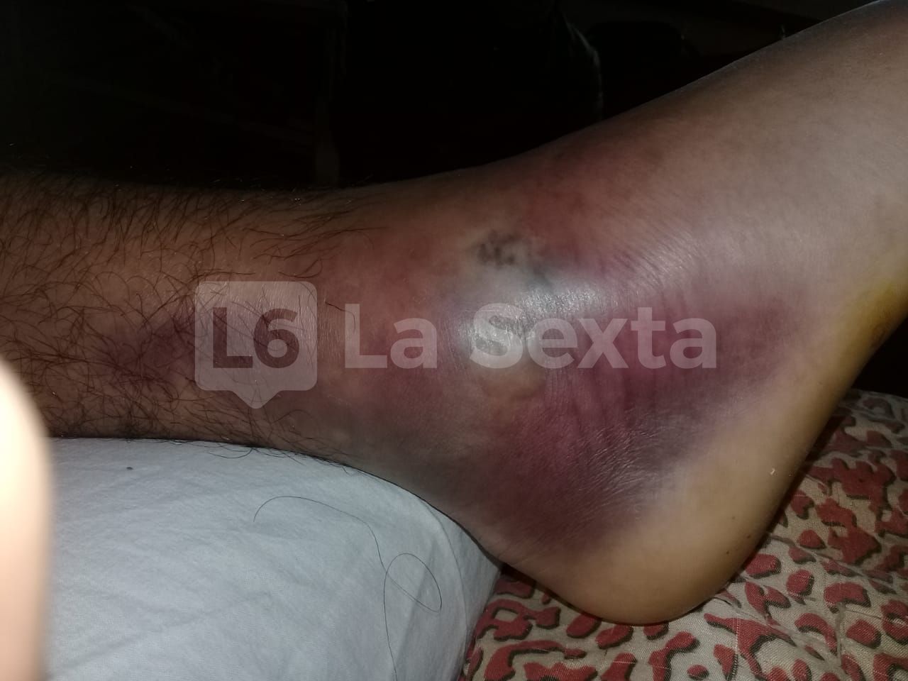 herida obra incompleta santa elena 6 result