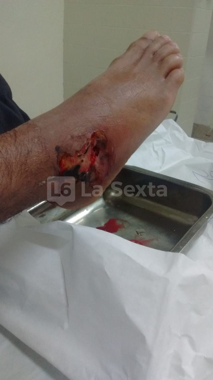 herida obra incompleta santa elena 7 result