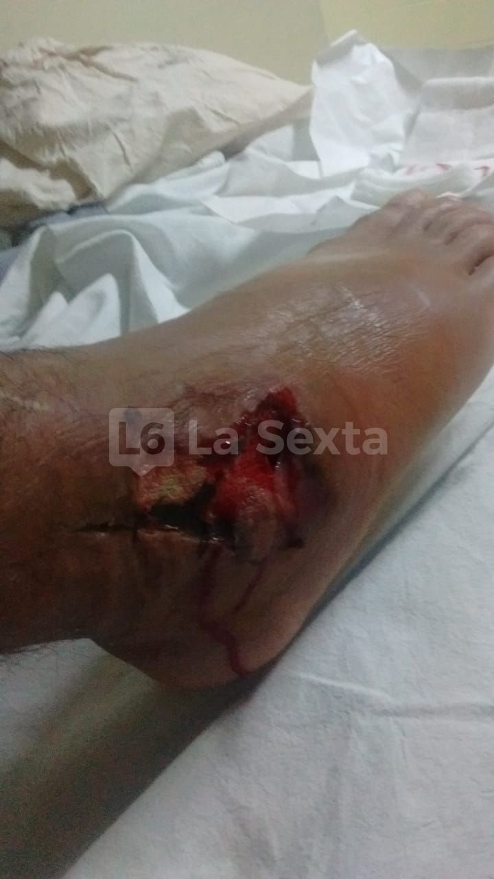 herida obra incompleta santa elena 8 result