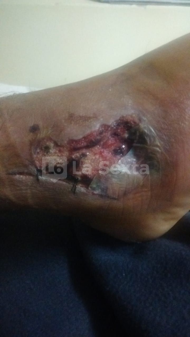 herida obra incompleta santa elena 9 result